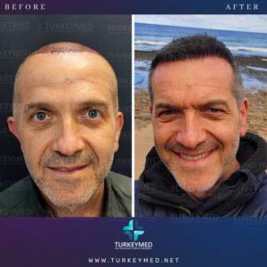 Before and after hair transplant