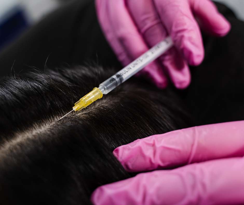 Mesotherapy Hair Loss Treatment